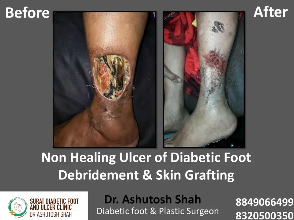 Diabetic Foot  PPT 3 checked by sir.pptx-65.webp